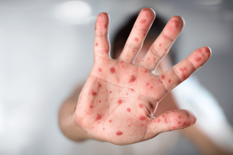 Se registraron 10 nuevos casos de viruela del mono en Argentina