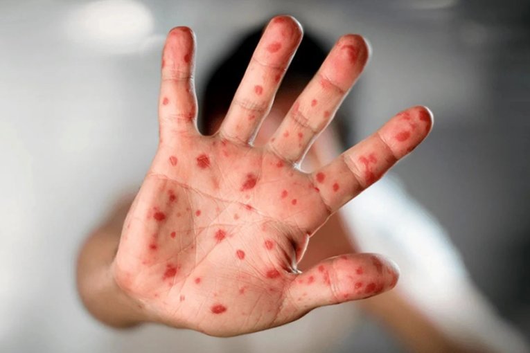 Viruela del mono: para la OMS, contin&uacute;a siendo una emergencia de salud p&uacute;blica