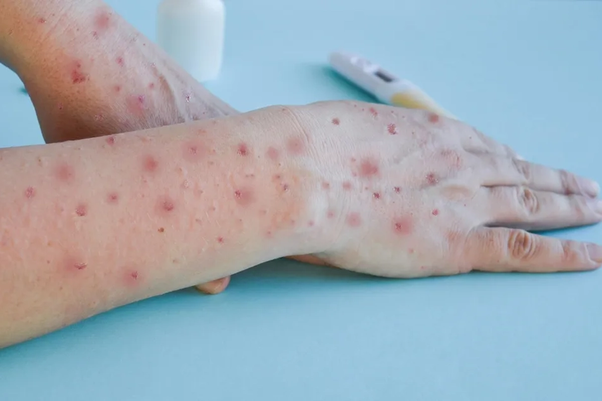 La viruela s&iacute;mica causa fiebre y lesiones cut&aacute;neas