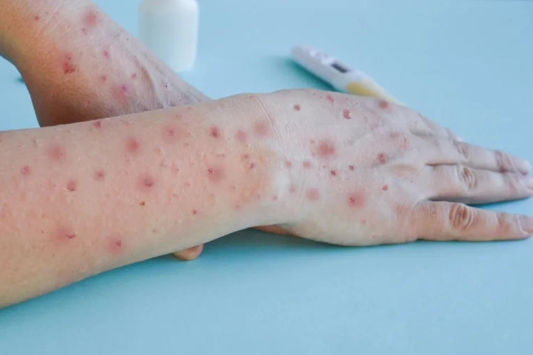 OMS alerta por nueva variante recombinante de viruela s&iacute;mica detectada en Reino Unido e India