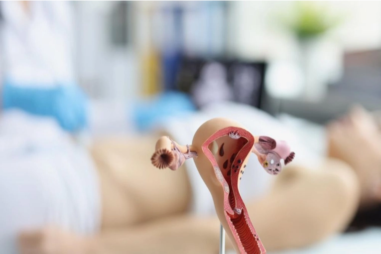 Endometriosis: advierten sobre los s&iacute;ntomas y la importancia del diagn&oacute;stico temprano