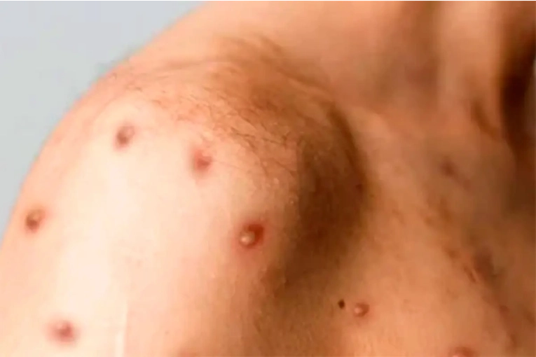 Confirmaron en Argentina el primer caso de viruela del mono de una variante m&aacute;s contagiosa