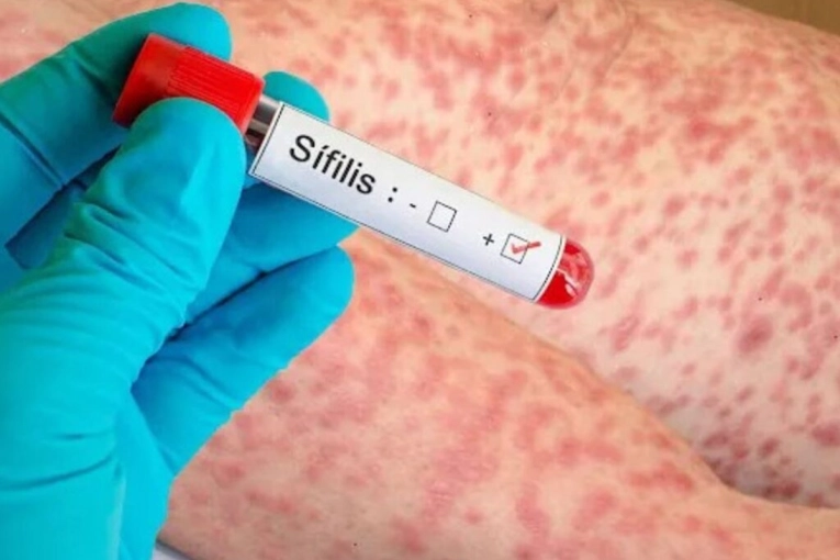 Alerta por s&iacute;filis en Entre R&iacute;os: los casos crecieron m&aacute;s del 65% en un a&ntilde;o